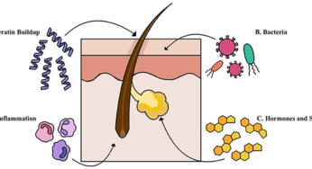 Pendekatan Nanoteknologi Untuk Penghantaran Bahan Aktif Farmasi Dalam Terapi Acne Vulgaris